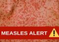 Measles Alert in El Dorado County: Urgent Measures Following Confirmed Case at UC Davis ED