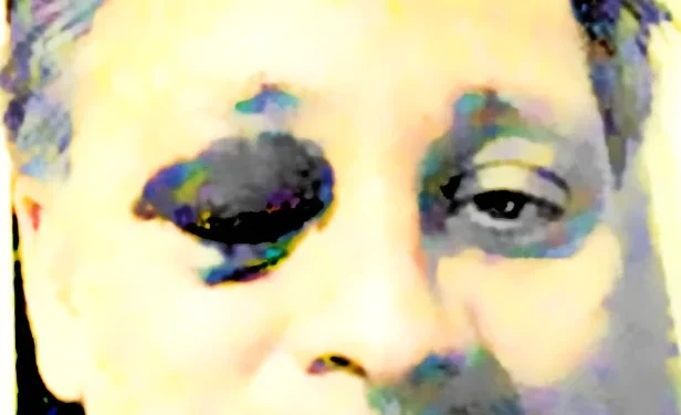 The Lobe Not Taken: Choosing a Life Beyond Epilepsy