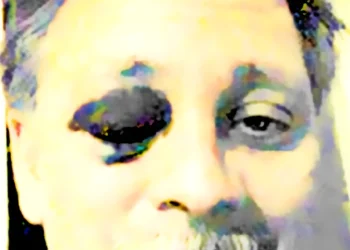 The Lobe Not Taken: Choosing a Life Beyond Epilepsy