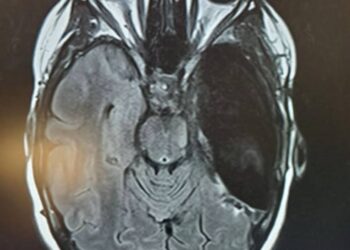 Why My Right Temporal Lobe Was Removed: Epilepsy, Mental Health, and the Road to Recovery