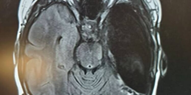 Why My Right Temporal Lobe Was Removed: Epilepsy, Mental Health, and the Road to Recovery